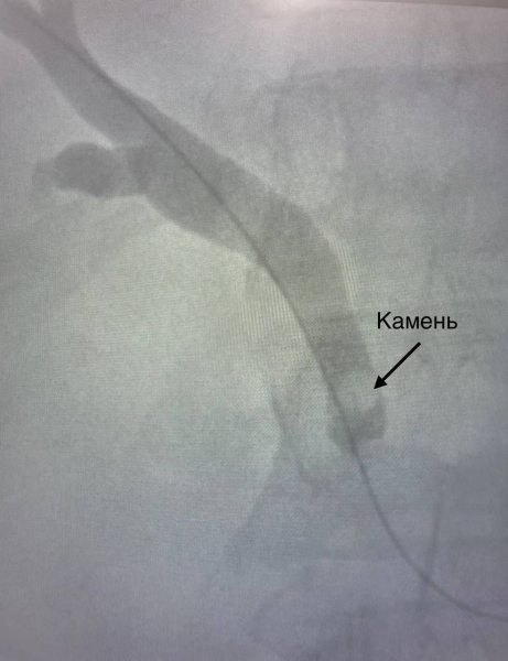 Камень, который застрял в желчном протоке челнинца, достали через небольшой разрез