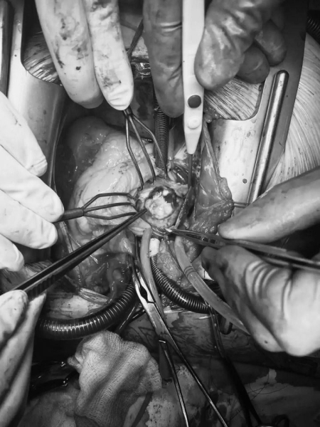 Держалась на &laquo;ножке&raquo;: в БСМП пациентке удалили опухоль размером с мяч для гольфа