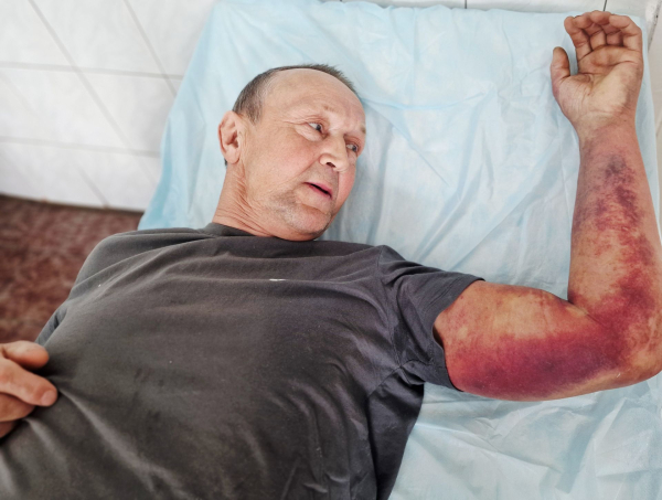 Укусили и змея, и клещ: мужчина чудом выжил после прогулки за крапивой